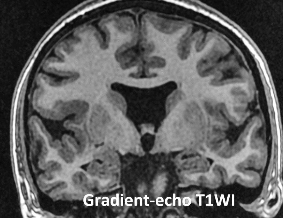 #AJNRcc >> December 13, 2021 >> What is the diagnosis for this 17-year-old girl with mild cognitive delay presents to the emergency department with new-onset seizure? Submit your answer at ow.ly/7Ago50HarI4.