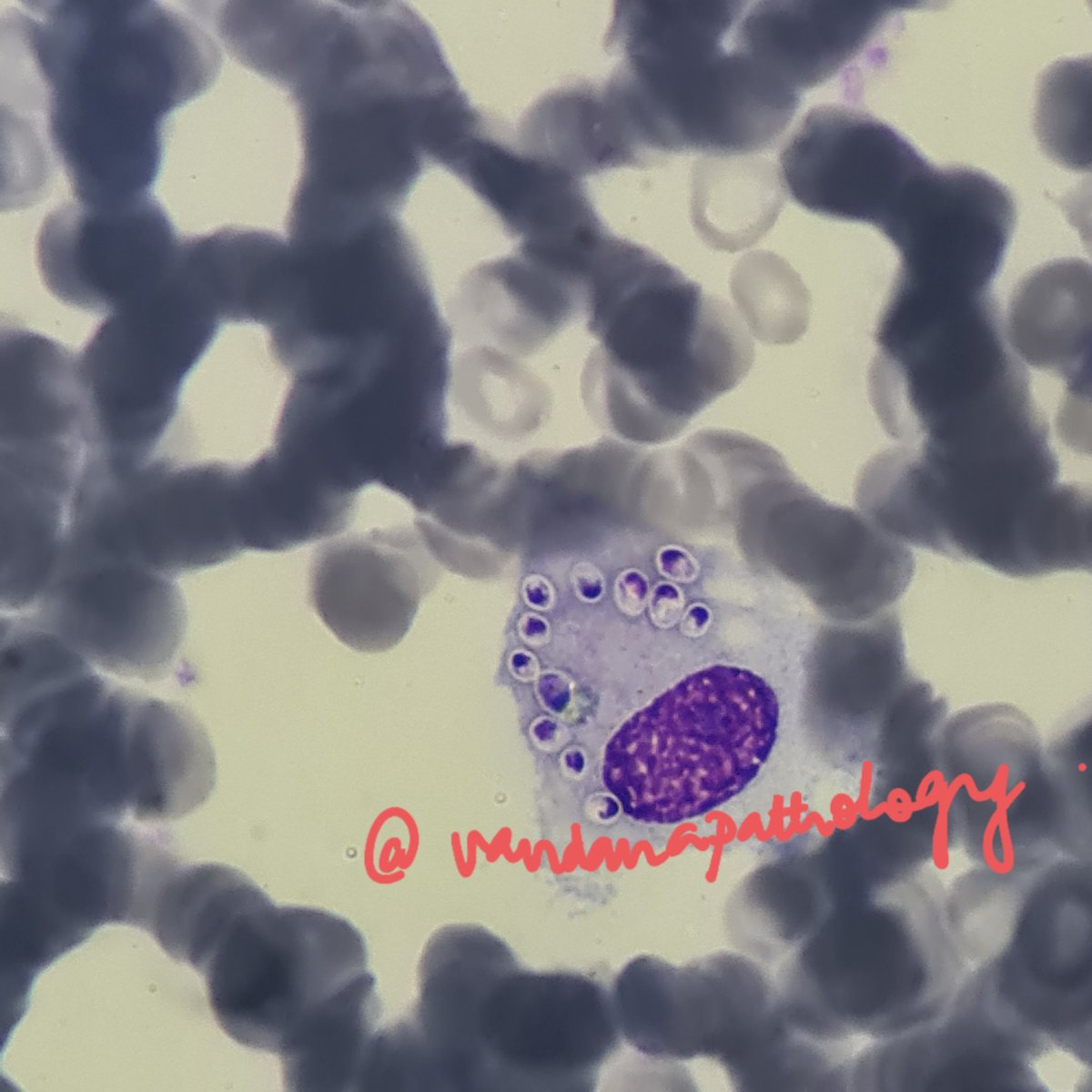 drvandanapuri's tweet photo. Who is hiding in the monocytes
Mind you , it's the peripheral smear 
Such a beautiful histoplasma .. https://t.co/JPlVZqw80B