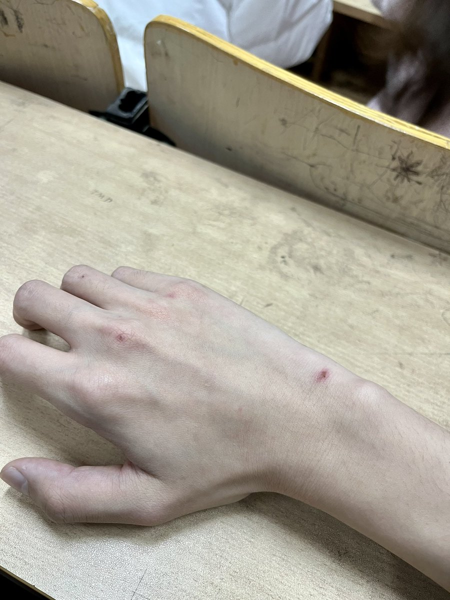 Sliver_Racing's tweet photo. 为什么手上总有莫名的伤啊 https://t.co/GRRqA7pI63