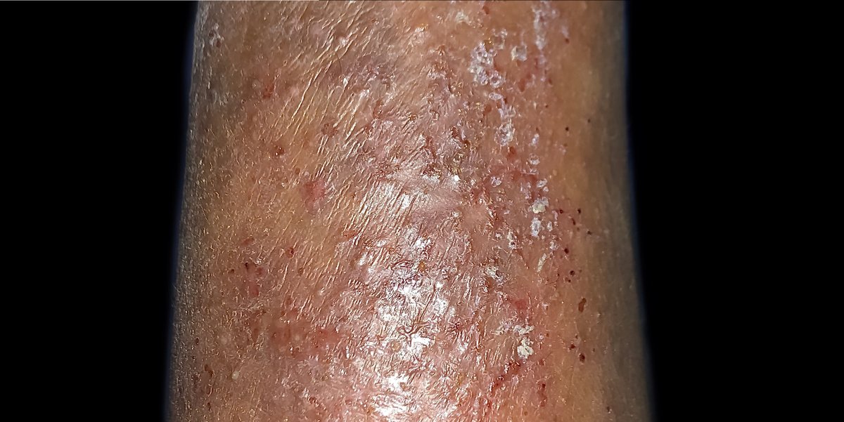 MDedgeDerm's tweet image. The oral #JAK1 inhibitor #abrocitinib has been approved in Europe for the treatment of moderate to severe AD in adults. ms.spr.ly/6010ZHMWe