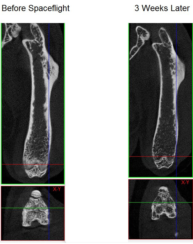 Simulating the effects of spaceflight on a femur. Don't even need to quantify bone loss. It's so apparent from looking at the CT scan pictures! 😨