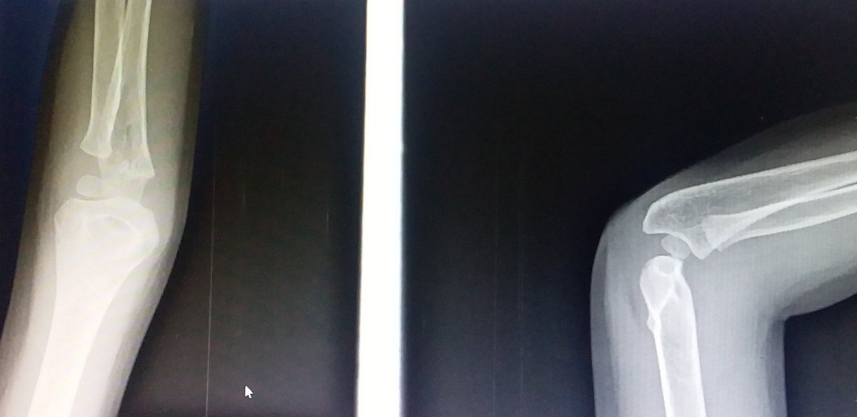 Paed Clinics of Dar, Tanzania 
(Nicholas and Ronald)
#Elbow injuries, children with elbow injuries warrant plain radiographs to evaluate for fracture or dislocation when physical findings show deformity, swelling. Further care is determined based on the radiographic findings.