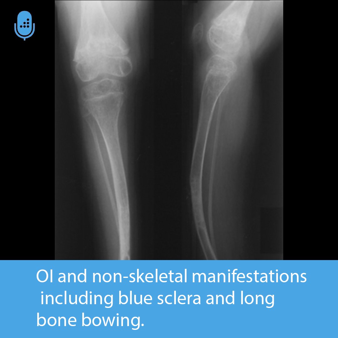 Orthobullets on X: Osteogenesis imperfecta (OI) is a genetic