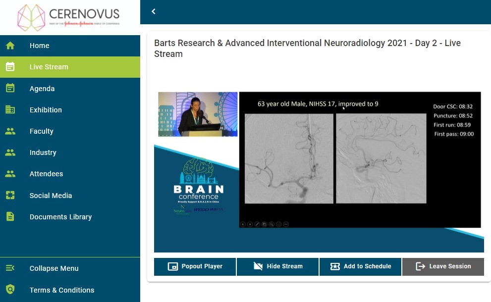 brainconferenc1's tweet photo. Live now at #BARTSBrainConference is Prof Sarah Power t of the @CERENOVUS_HQ session with their talk: M2 clots. Aspiration vs Stent Retrievers. Let’s Talk about it.

A must watch! https://t.co/anQpBWj510 https://t.co/kMzLxZ1LI8