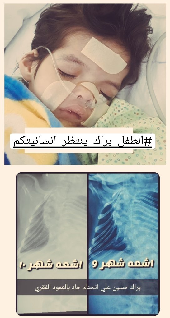 #الطفل_براك_يستنجد_بالعالم

كل شهر يشتد انحناء العمود الفقري
وتسوء حالة #براك_حسين 
بإسم لا اله الا الله قفوا معنا ساندونا
لانقاذ طفلي ، من هذه الكارثه الانسانيه
مازلنا نناشد والى الان لم يتم اجلاء براك
ولم يتم الالتفات لعلاجه بالخارج
حيث ان العمليه فالكويت عاليه الخطوره