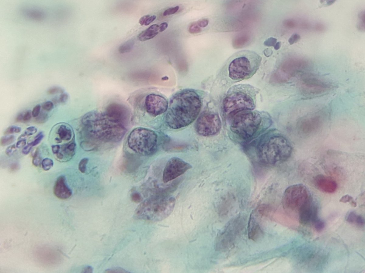 PSzwebel's tweet photo. Conventional PAP smears
HSIL
Nuclear membrane irregularity
Clumpping chromatin
Increase nuclear cytoplasm ratio https://t.co/suIizEq58e
