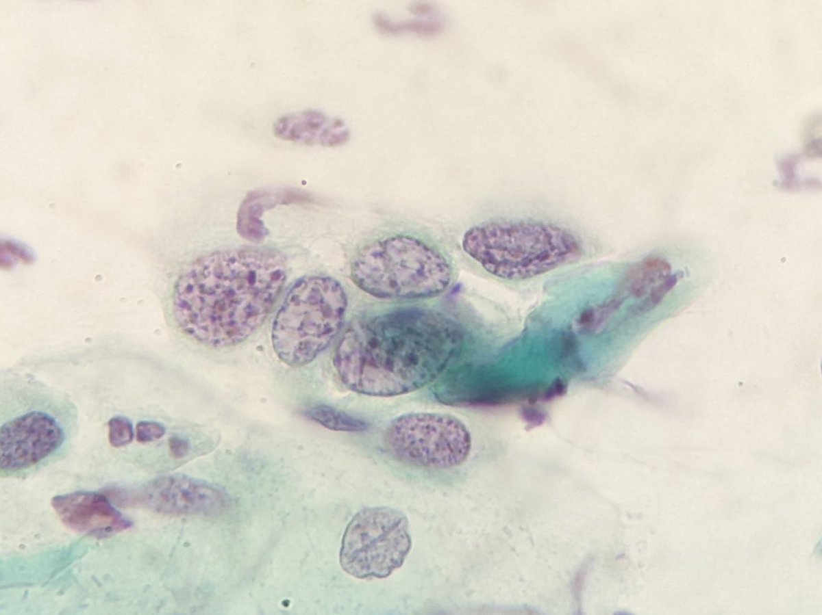 PSzwebel's tweet photo. Conventional PAP smears
HSIL
Nuclear membrane irregularity
Clumpping chromatin
Increase nuclear cytoplasm ratio https://t.co/suIizEq58e