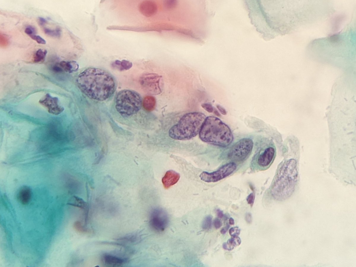 PSzwebel's tweet photo. Conventional PAP smears
HSIL
Nuclear membrane irregularity
Clumpping chromatin
Increase nuclear cytoplasm ratio https://t.co/suIizEq58e
