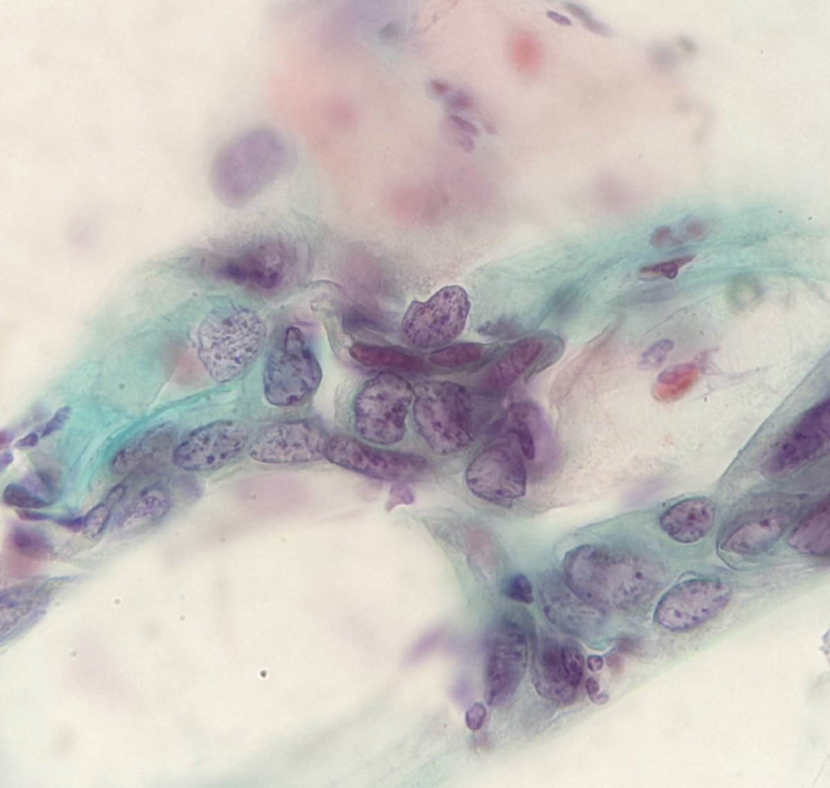 PSzwebel's tweet photo. Conventional PAP smears
HSIL
Nuclear membrane irregularity
Clumpping chromatin
Increase nuclear cytoplasm ratio https://t.co/suIizEq58e