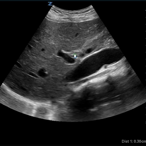 New York ACEP (@nyacep) on Twitter photo View "Sound Rounds: Getting to the Heart of Acalculous Cholecystitis" in the latest Empire State EPIC issue. nyacep.org/newsletter-jun… View "Sound Rounds: Getting to the Heart of Acalculous Cholecystitis" in the latest Empire State EPIC issue. nyacep.org/newsletter-jun…