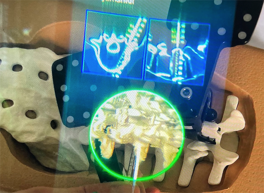 PeterCoffaro's tweet photo. First in-human report of the clinical accuracy of thoracolumbar percutaneous pedicle screw placement using augmented reality guidance

https://t.co/tWLC6yXeoZ

@TheJNS #AR #AugmentedReality #CAS #ComputerAssistedSurgery #SpineSurgery #MixedReality #PedicleScrews #SpineNavigation https://t.co/gAbS8kFREl