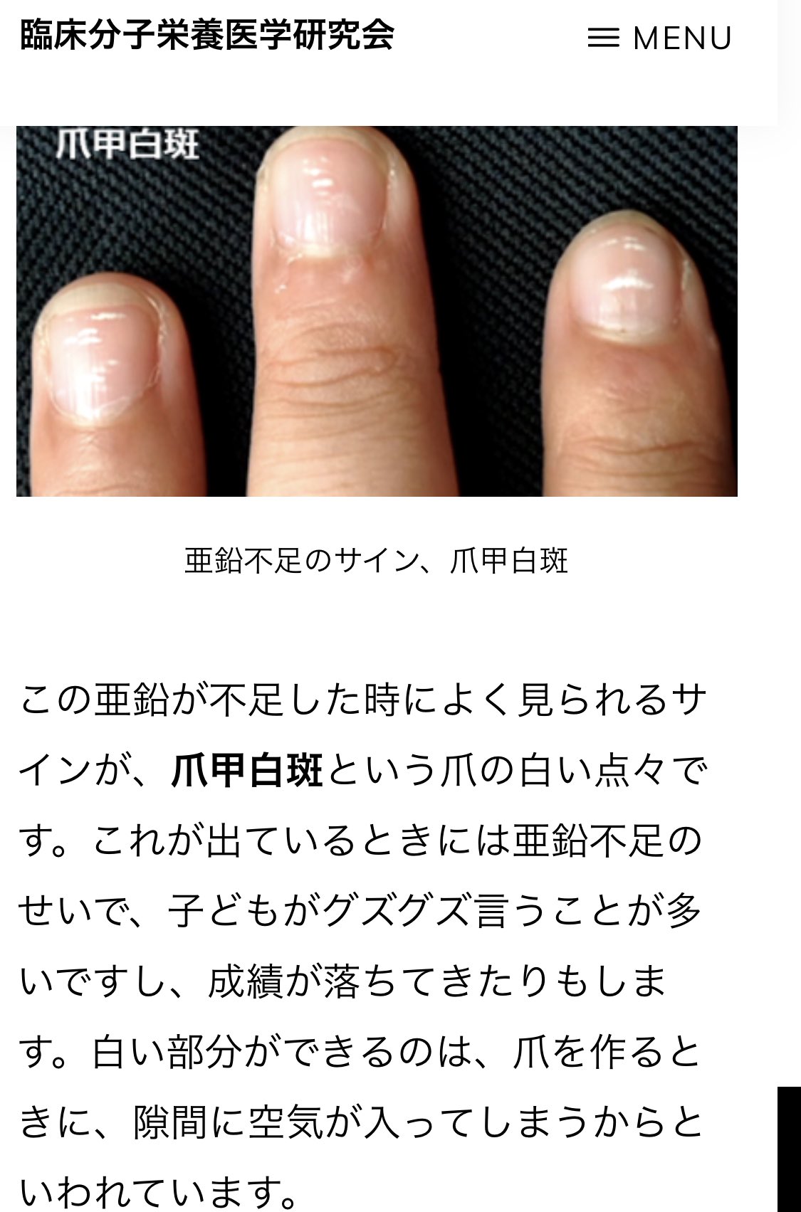 ニ シ ハ 爪甲白斑だけじゃなくて 深爪だったりボコボコ爪だったり ささくれだってる子とかも多い 勉強できないから塾に行かせる の前に栄養不足を当たり前に思いつける子育てがもっと出来たらいいなぁと思う Twitter