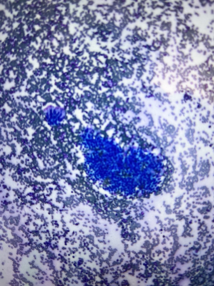 Learning from my rapid on-site cytologist. Bronchial cells have cilia ( purple halo) whereas malignant cells don’t ( large cluster). ⁦@SABronchoscopy⁩ ⁦@AAB_IP⁩ ⁦@WCM_CTSurgery⁩