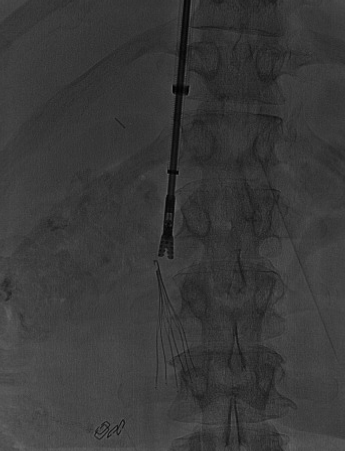 mamillyA's tweet photo. Removing this IVCF was not an easy task! After the Alligator forceps failed to do so, we eventually had to create a hook using 5fr MPA catheter, One snare and a wire. #Filterout #IVCF #IRAD https://t.co/zPi5yJpsQ7