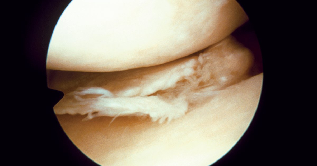 WebMD's tweet photo. Meniscus tears are a special risk for older athletes since the meniscus weakens with age. More than 40% of people 65 or older have them. https://t.co/qxCcaZk1Kk https://t.co/KxQW9mCzyY
