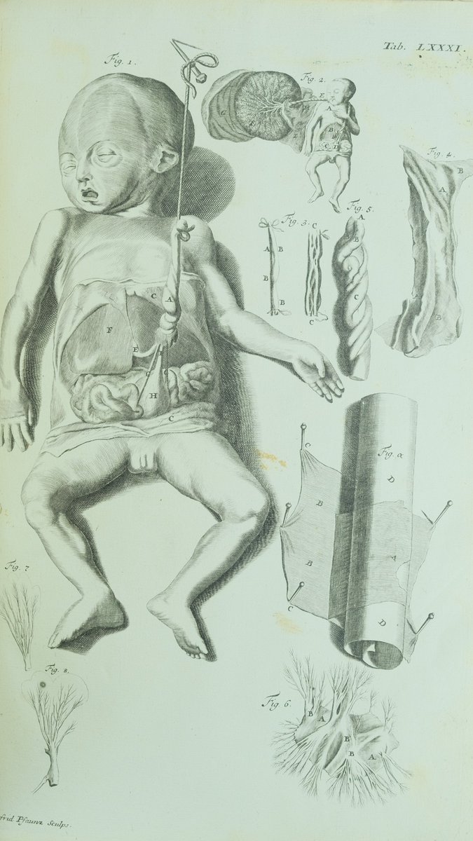 BibyArchRANME's tweet photo. La lámina LXXXI del "Theatrum anatomicum" de #Manget (#Ginebra, 1717), grabado realizado por Gottfried #Pfauntz (1687-1760), es una representación de los vasos del cordón umbilical del #feto humano #BibliotecaHistórica #LibroAntiguo #SigloXVIII #Anatomía
https://t.co/nLvinhDZuN https://t.co/FdWCnsAE8K