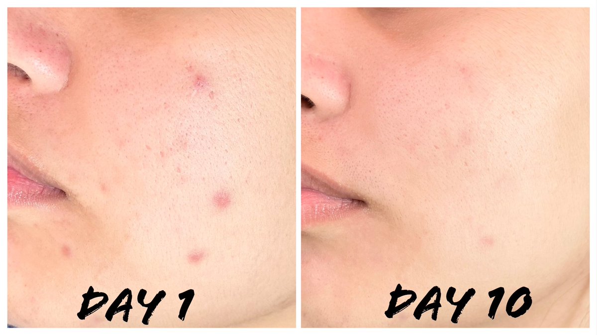 สิวกับแมสก์เป็นของคู่กันใส่ที่ไรทำสิวขึ้นหนักมากก จนได้ลองใช้ นีเวีย คลีนซิ่ง แอคเน่แคร์ มา 10 วันผิวดีขึ้น!! เช็ดสะอาดไม่พอยัง #เช็ดดักสิว ได้ด้วย ตอบโจทย์คนเป็นสิวสุดๆ ไม่ว่าเมคอัพแน่นติดทนแค่ไหนก็สะอาดเกลี้ยงแค่ 2 ปาด ไม่ระคายเคืองผิว ยังช่วยลดแบคทีเรียสิวด้วยน้า  #รีวิวนีเวีย