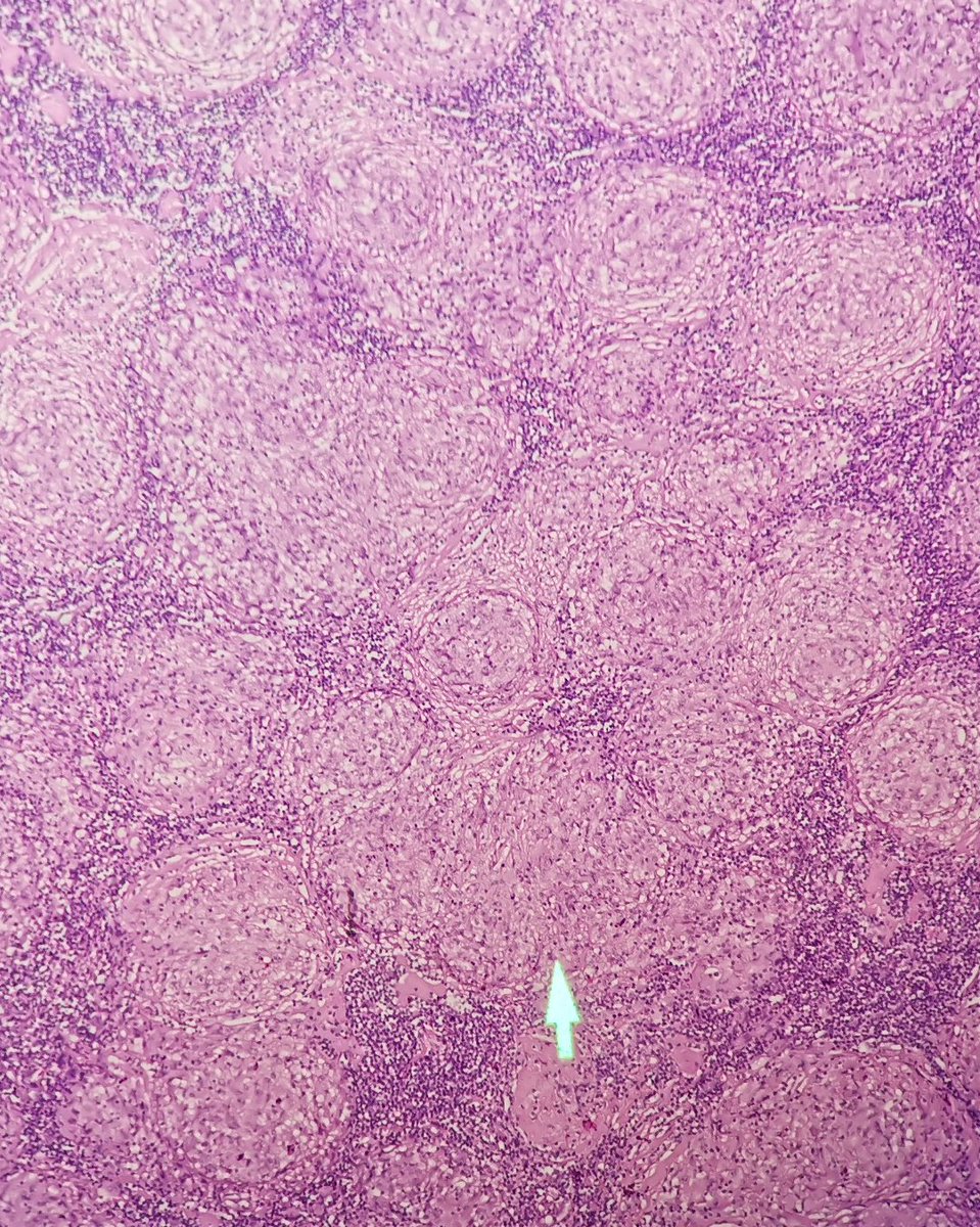 Andy_pathology's tweet photo. sarcoidosis https://t.co/x8Tem3xe96