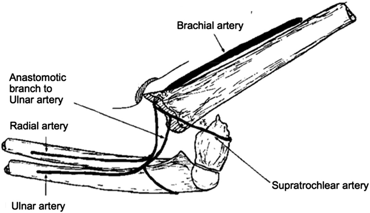 jbjs's tweet photo. Updated #pediatrics #trauma #humeral #fracture #JBJSClinicalSummary on Supracondylar Humeral Fractures by Paul D. Sponseller, MD @HopkinsOrtho
https://t.co/TkJHM3ILtw https://t.co/mVmaxPRdWN
