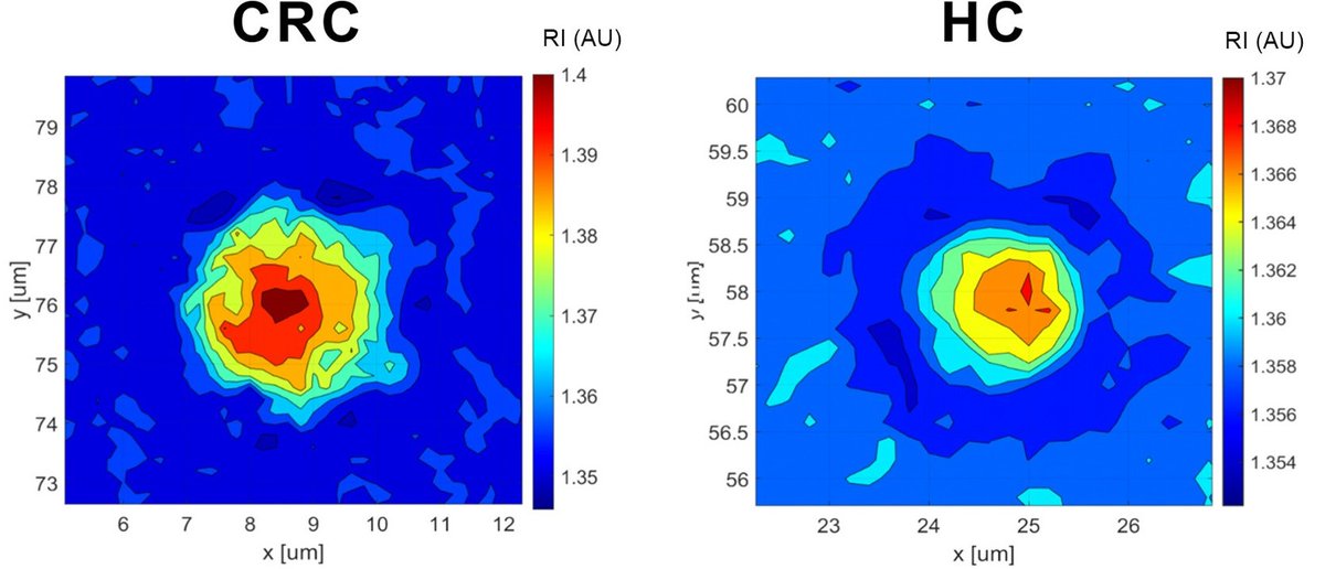 Label-Free Quantitative Phase Imaging Reveals Spatial Heterogeneity of #ExtracellularVesicles in Select Colon Disorders. FREE Biophysical Imaging article from <a href="/umed_wroc/">umed_wroc</a>,  <a href="/PWr_Wroclaw/">Politechnika Wrocławska</a>,  and <a href="/uniwroc/">UNIWROC</a>. ajp.amjpathol.org/article/S0002-…. #coloncancer #UlcerativeColitis #IBD #colorectalcancer
