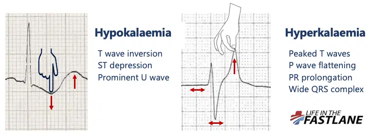 justtmar's tweet photo. Bastante útil y visual cuando eres R1, te asustas con un potasio y no te acuerdas de cómo se veía la hipopotasemia en el ECG😊 https://t.co/sKXPJlQwjy