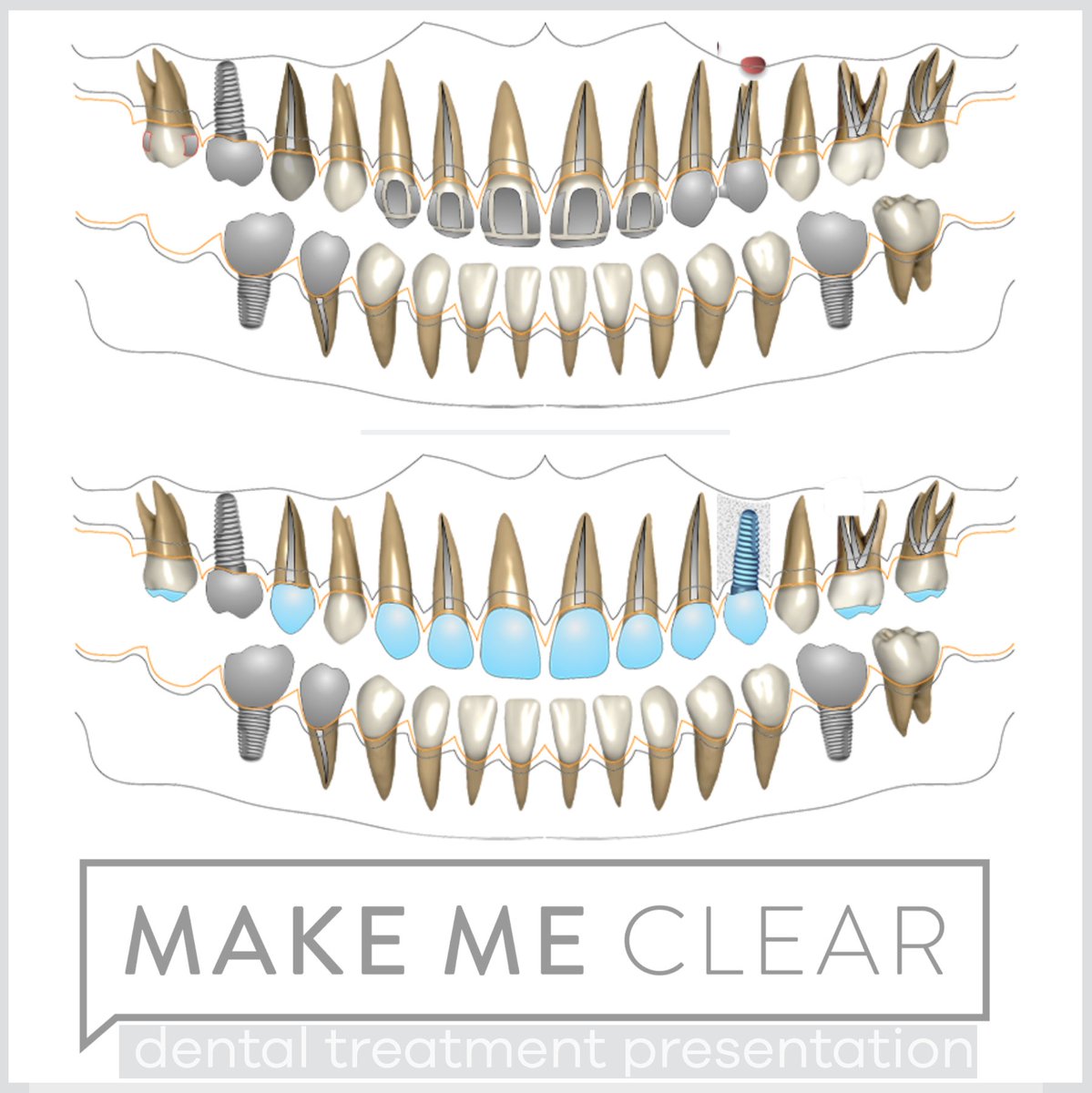 makemeclearapp's tweet photo. https://t.co/GTFH40K8LC

•
•
•
•
•

#treatmentplanning #dentistry #dentalsoftware #treatmentplanpresentation #planpresentation #communicationindentistry #interdisciplinarydentistry
#dentalmarketing https://t.co/rFhpbuL7MU