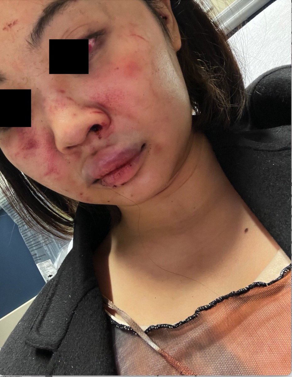 Bew recently moved to NYC from Thailand. She’s traumatized by the incident, but tonight she spoke bravely to <a href="/jimdolan7/">Jim Dolan</a> hoping her voice will lead to an arrest.