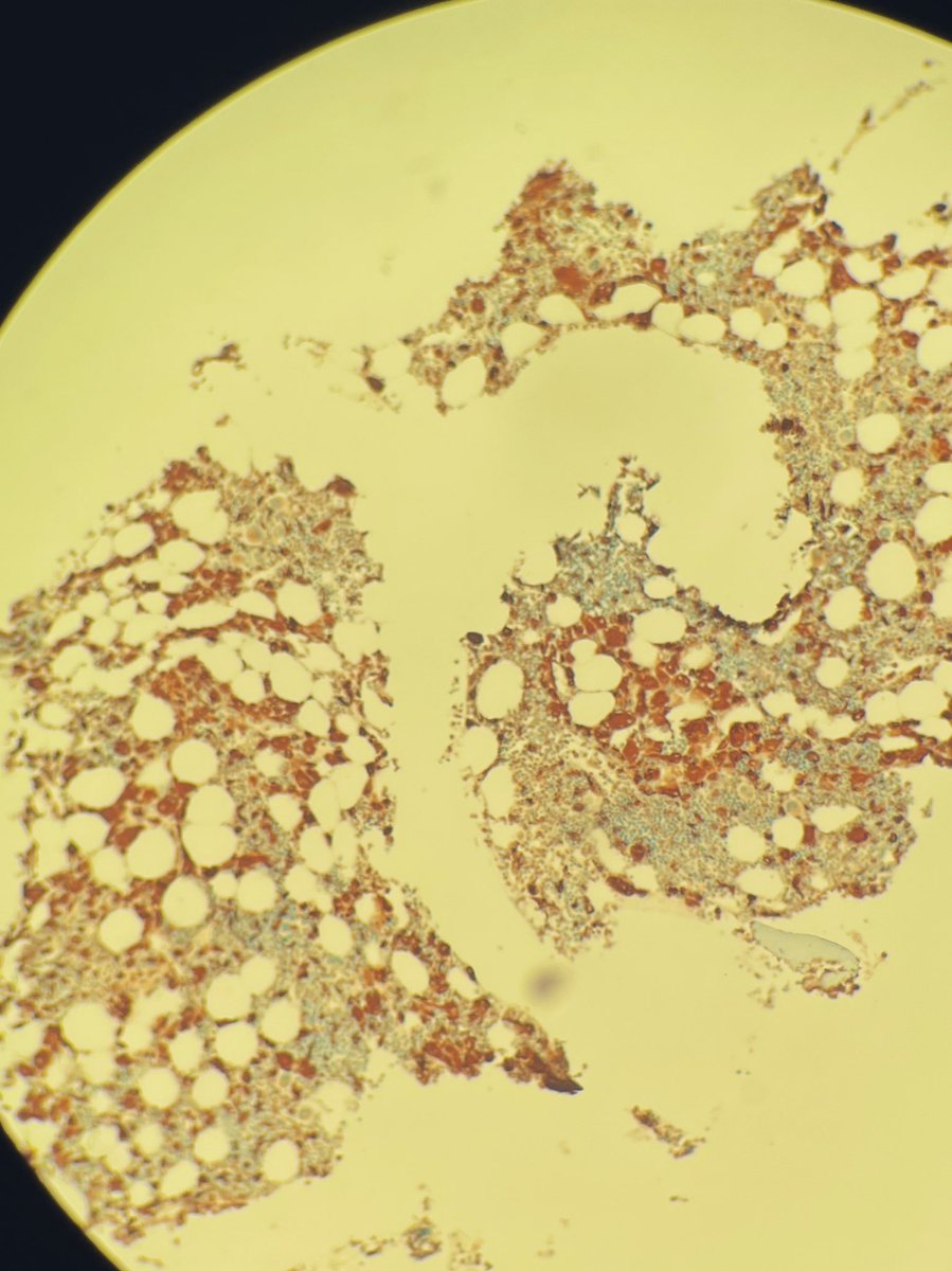 MarrowandBlood's tweet photo. Additional stains 1: Perls 2x CD68 https://t.co/ROwtTHNrLj