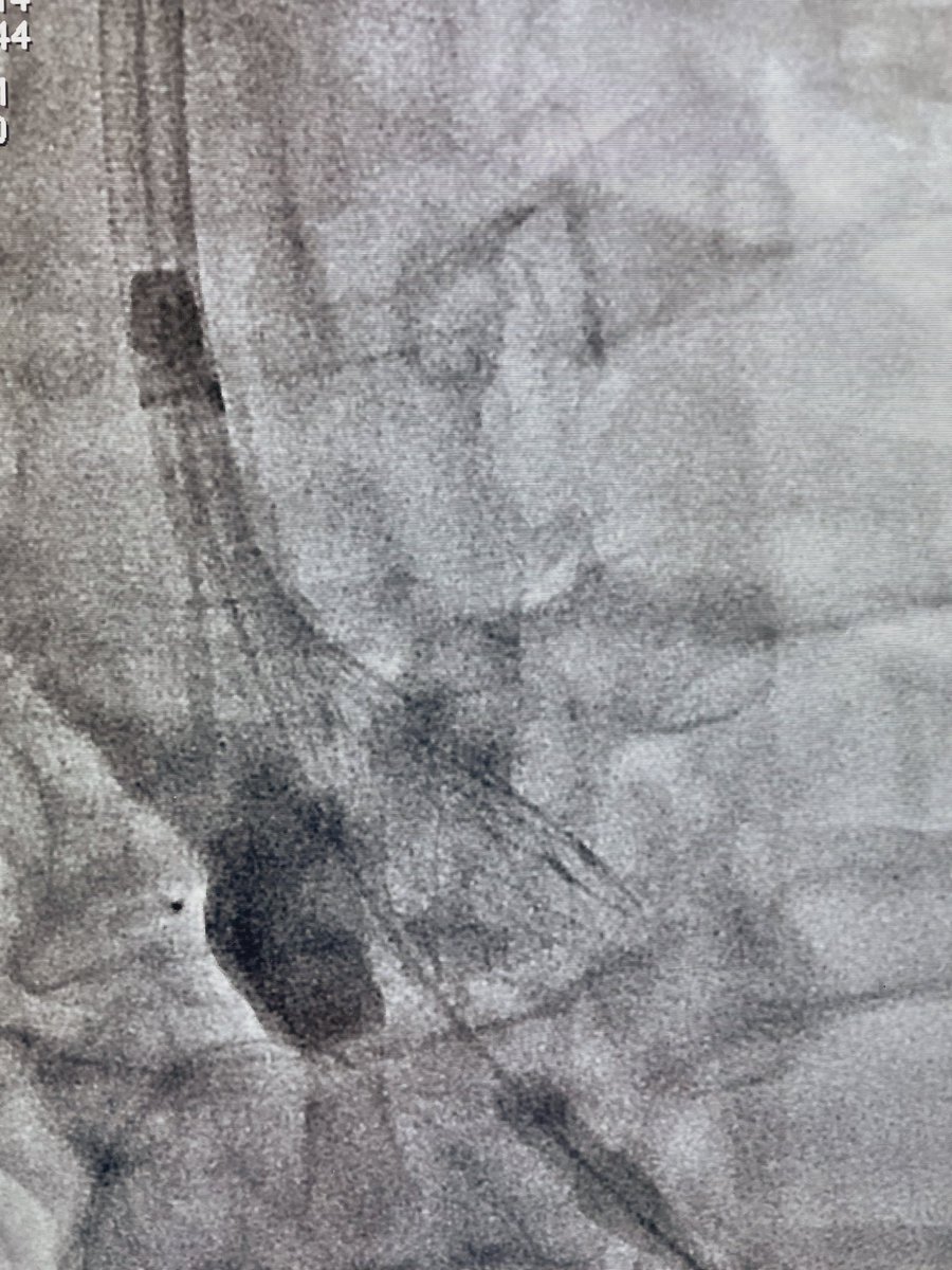 Ditongaje's tweet photo. Transaxillary TAVI using Evolut Pro Plus 29mm. Latest generation of Evolut Valve with 14F sheath size is beneficial for Asian population who usually have smaller artery size. #tavi #tavr #structuralheartintervention #medtronic #cardiotwitter #nuhcs https://t.co/Ok1DaQ1lFn