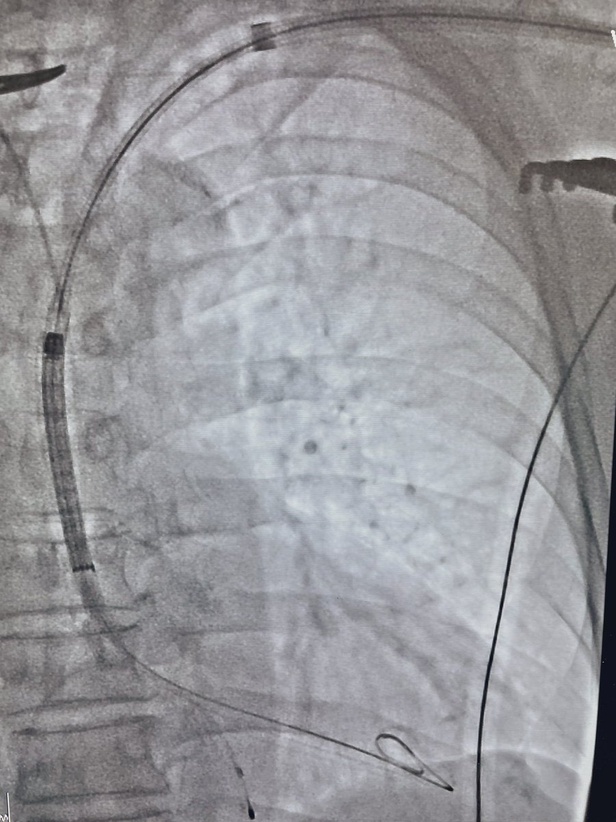 Ditongaje's tweet photo. Transaxillary TAVI using Evolut Pro Plus 29mm. Latest generation of Evolut Valve with 14F sheath size is beneficial for Asian population who usually have smaller artery size. #tavi #tavr #structuralheartintervention #medtronic #cardiotwitter #nuhcs https://t.co/Ok1DaQ1lFn
