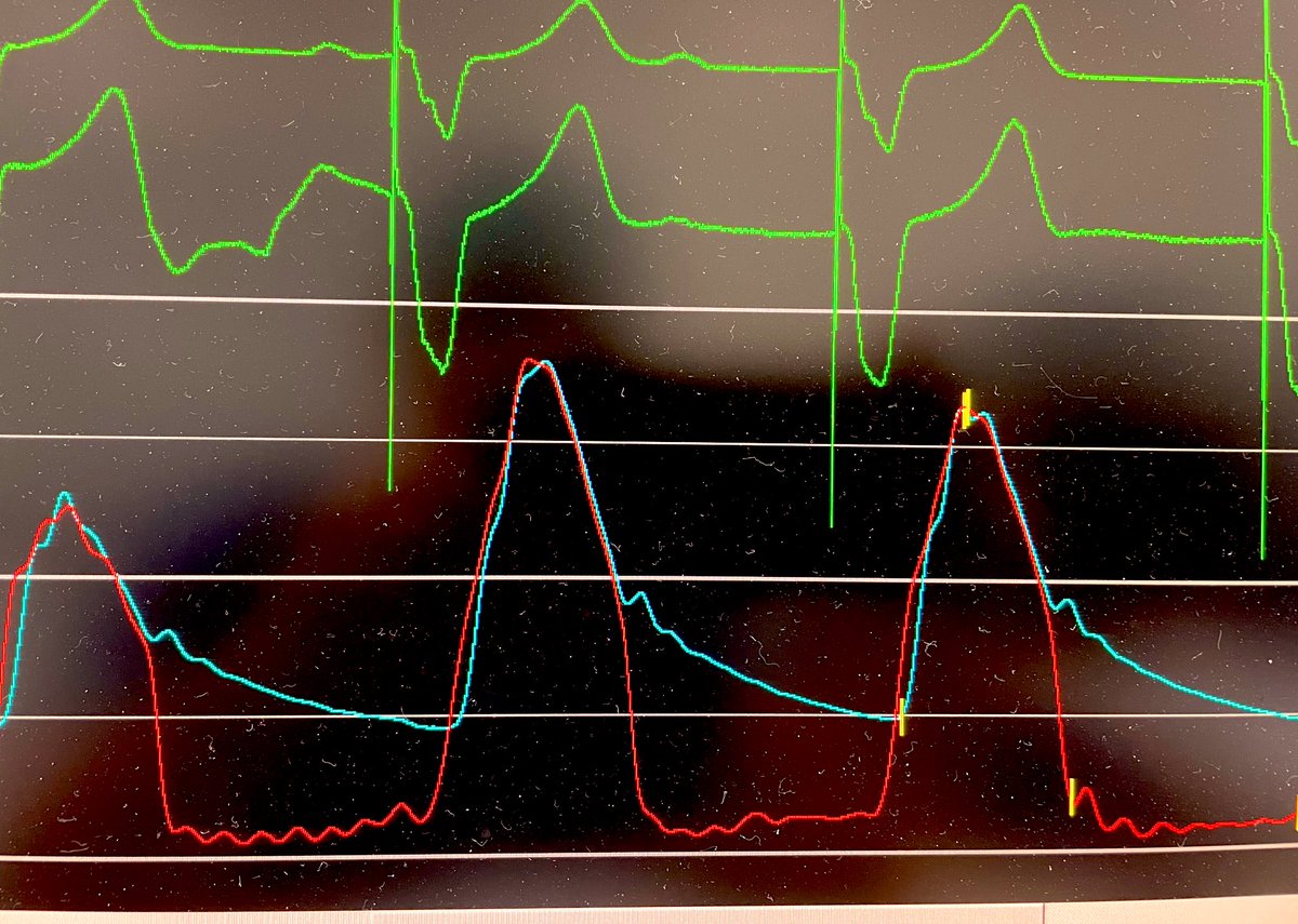 Ditongaje's tweet photo. Transaxillary TAVI using Evolut Pro Plus 29mm. Latest generation of Evolut Valve with 14F sheath size is beneficial for Asian population who usually have smaller artery size. #tavi #tavr #structuralheartintervention #medtronic #cardiotwitter #nuhcs https://t.co/Ok1DaQ1lFn