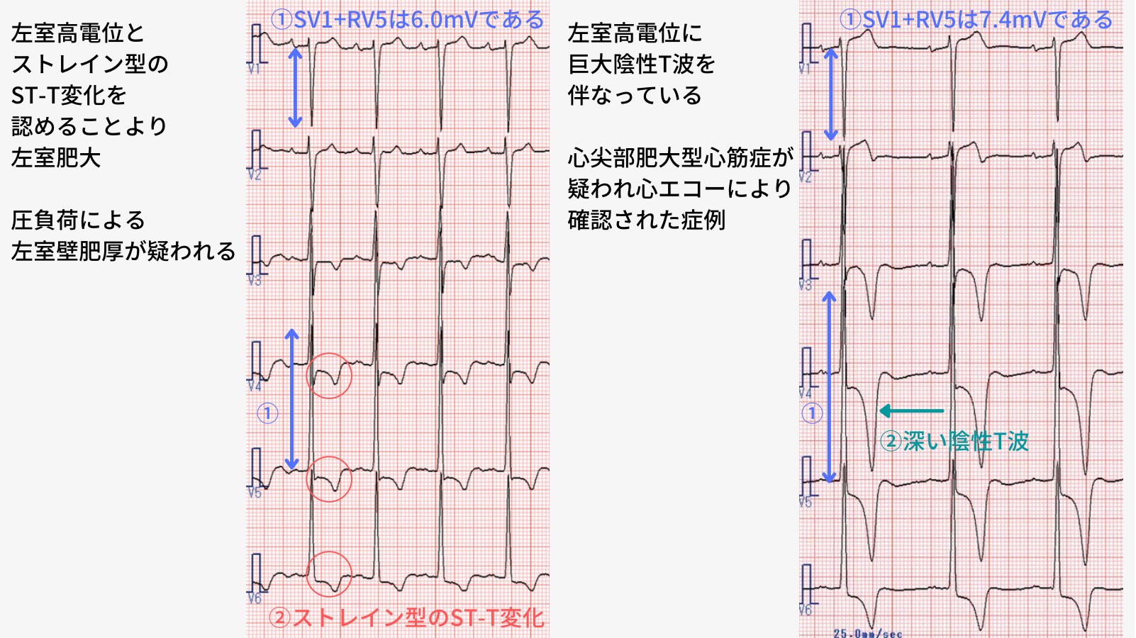 心電図くま on X: 