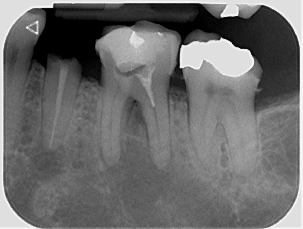 johnrhodesendo's tweet photo. RCT LL6 with perf repair of micro-perforation in furcation. https://t.co/sNYJ7Tsorc Gold prep Primary @DentsplySirona @BetterEndo composite repair and core build up with SDR and Ceram-X review in 6 months
#savingteeth # endodontics https://t.co/ADQuUXkZP4
