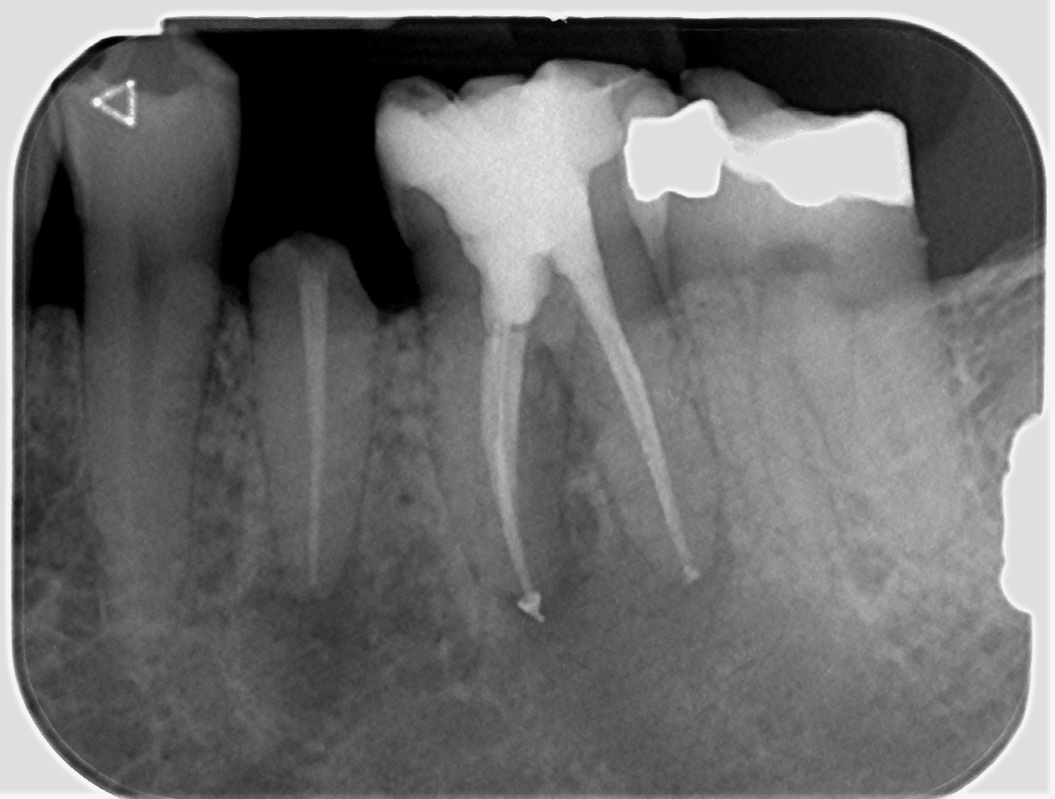 johnrhodesendo's tweet photo. RCT LL6 with perf repair of micro-perforation in furcation. https://t.co/sNYJ7Tsorc Gold prep Primary @DentsplySirona @BetterEndo composite repair and core build up with SDR and Ceram-X review in 6 months
#savingteeth # endodontics https://t.co/ADQuUXkZP4