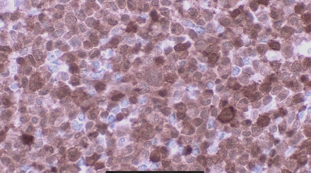JCandidoXavier's tweet photo. Langerhans cell histiocytosis

Male, 1 y/o, skin and skull lesion.
Grooved, folded and lobulated nuclei.
Many eosinophils.
 HE, CD1a, S100, CD4.

#path #pathclues #dermpath #hemepath #surgpath #medtwitter https://t.co/J9v8db7cAR
