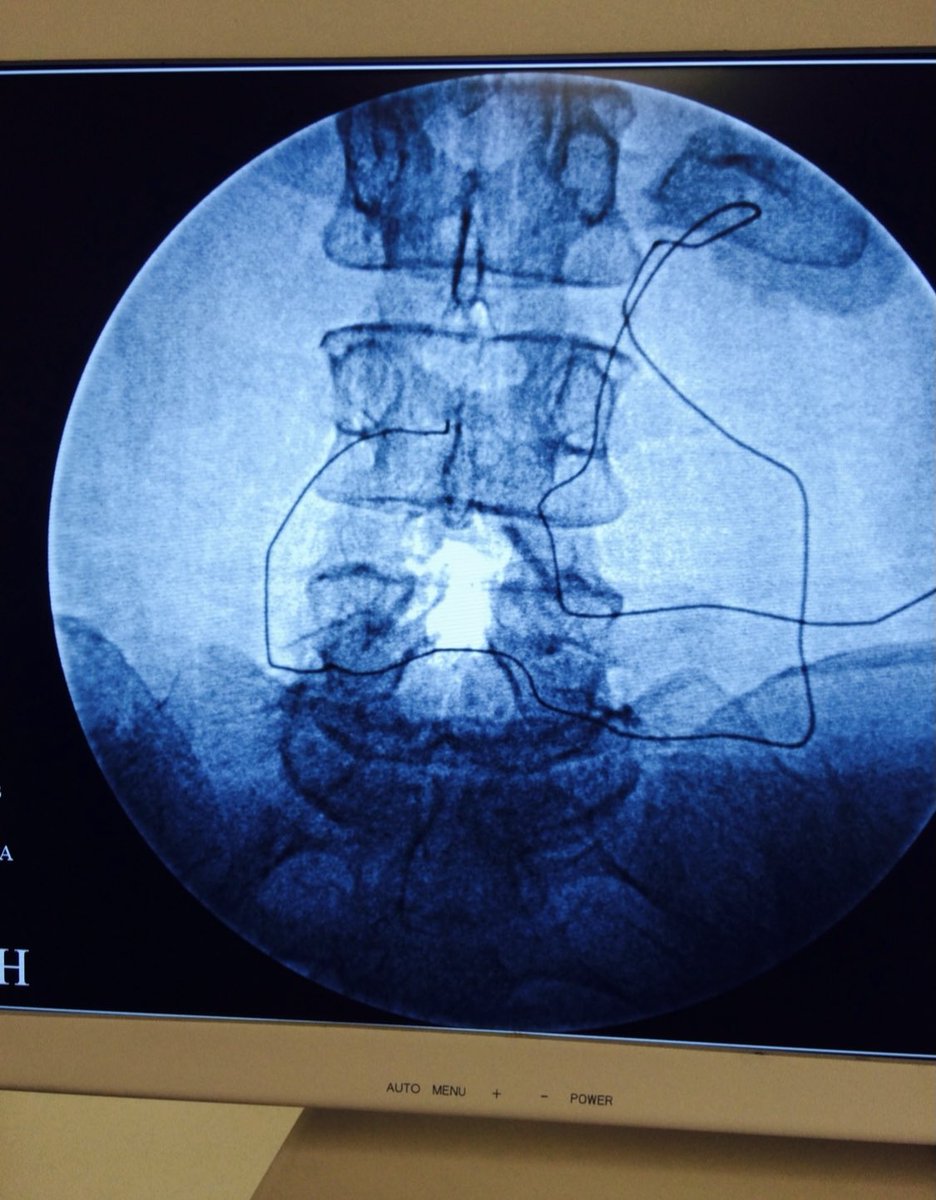tariqtramboo's tweet image. You do not get innovation for free – you have to allocate time, money and people.
Worlds first complete Laminectomy (spine surgery) done on a cadaver with a zero incision, through epidural space in 10min with a technique discovered by Me & team #SpineLoop.
#Spine
#innovation