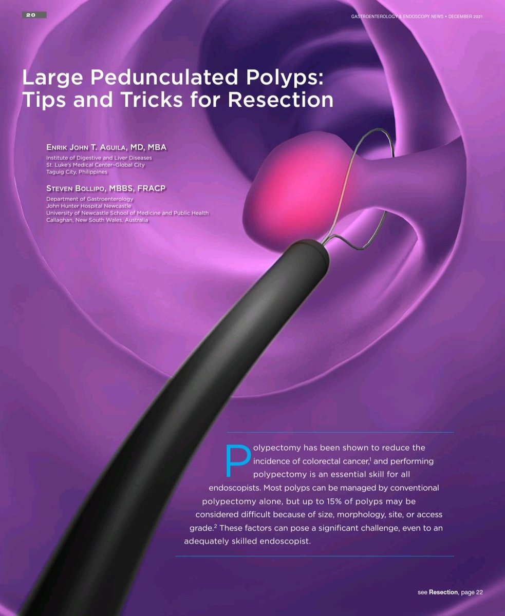 enrrikke's tweet photo. Large pedunculated polyps can be satisfying to resect but also can become very complicated quickly.

Check out tips and tricks for resection of large pedunculated polyps. Glad to share our review 😉 @gastroendonews @stevenbollipo #GITwitter #Twitter2Paper

https://t.co/dQOvAkmqTw https://t.co/Og6Do0uadf
