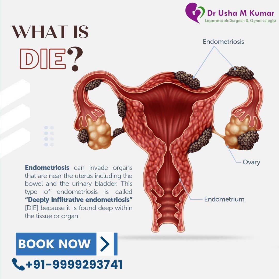 DrUshaMKumar's tweet photo. There are many types of Endometriosis, ‘DIE’ is onw of them.
Learn more about it in this post and ask question in the comment section below.

Book an appointment now at +91-9999293741 

#Obgyn #Obstetrician #WomensHealth #Gynecologist #Endometriosis #EndometriosisAwareness https://t.co/AZiYbvXqKE