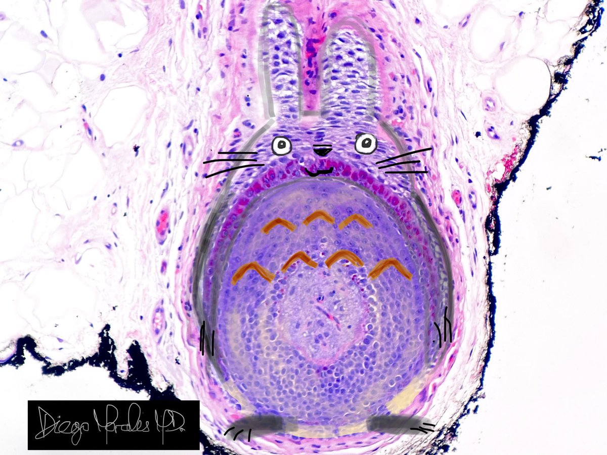 A time to remember the classic “Totoriform” hair bulb. 

#PathTwitter #pathmemes #pathmeme #dermtwitter