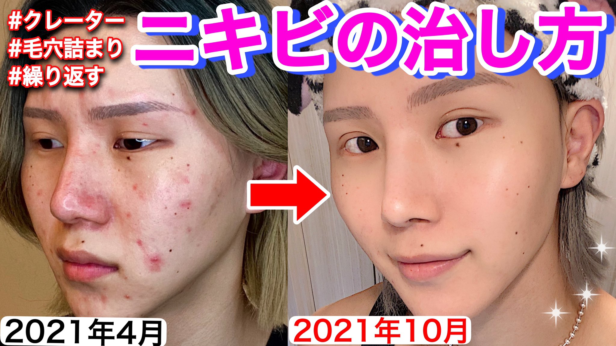 Gyutae ギュテ 激変 ニキビ40個の真っ赤な顔から2ヶ月以上ニキビが再発しなくなった僕のスキンケアを紹介します T Co Velxtwmuhm ニキビの治し方 ニキビ跡 毛穴詰まり T Co 7g4dwj3pcv Twitter