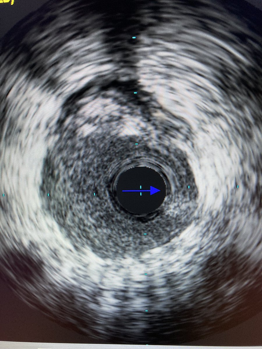 Matt Evans (@mevansmd) on Twitter photo Proud to have been part of the first <a href="/ShockwaveIVL/">Shockwave Medical</a> coronary case at @CharlestonVAMC! Great case with great mentor <a href="/ArasiMaran/">Arasi Maran</a> - just another day in the life of <a href="/MUSCCardFellows/">MUSC Cardiology Fellowship Programs</a> Proud to have been part of the first <a href="/ShockwaveIVL/">Shockwave Medical</a> coronary case at @CharlestonVAMC! Great case with great mentor <a href="/ArasiMaran/">Arasi Maran</a> - just another day in the life of <a href="/MUSCCardFellows/">MUSC Cardiology Fellowship Programs</a>