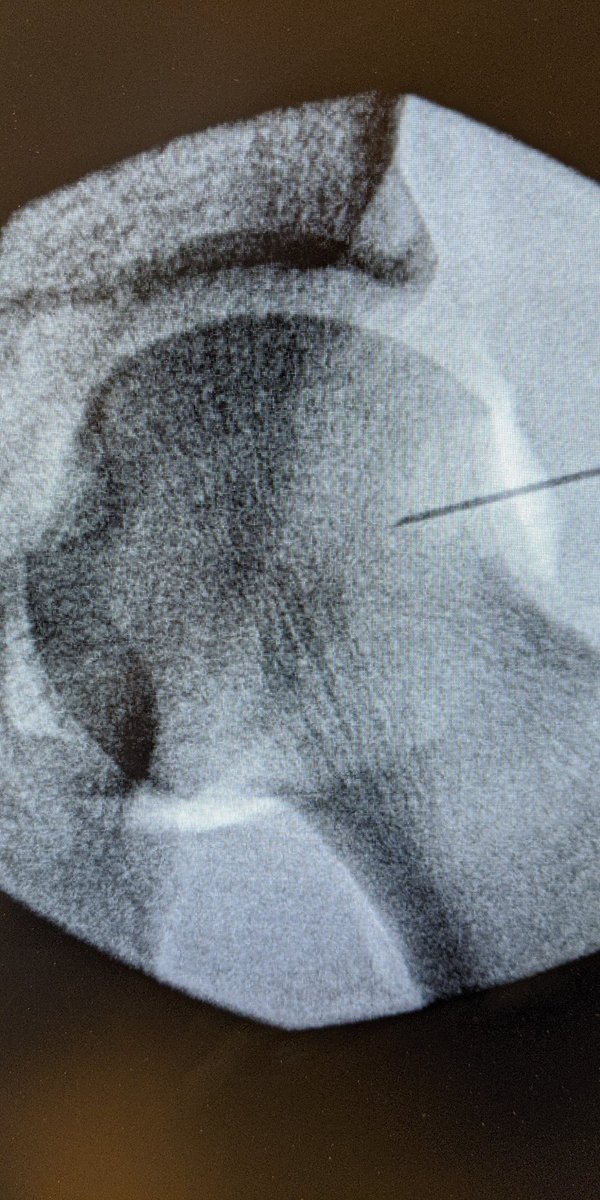 Painful hip but want to try to avoid a surgery? @MUOrthopaedic offers hip cortisone injection done under X-ray or ultrasound guidance to pin point your pain and get you back in action in just a few minutes! #hippain #cortisone #injection #MedTwitter #outpatient #airarthrogram
