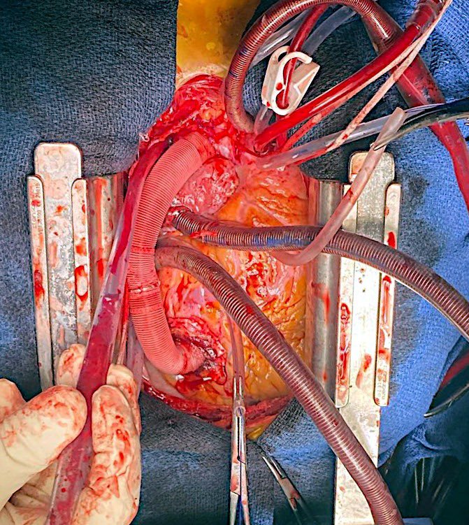 Cardiac Surgery Vall Hebrón Hospital tweet media