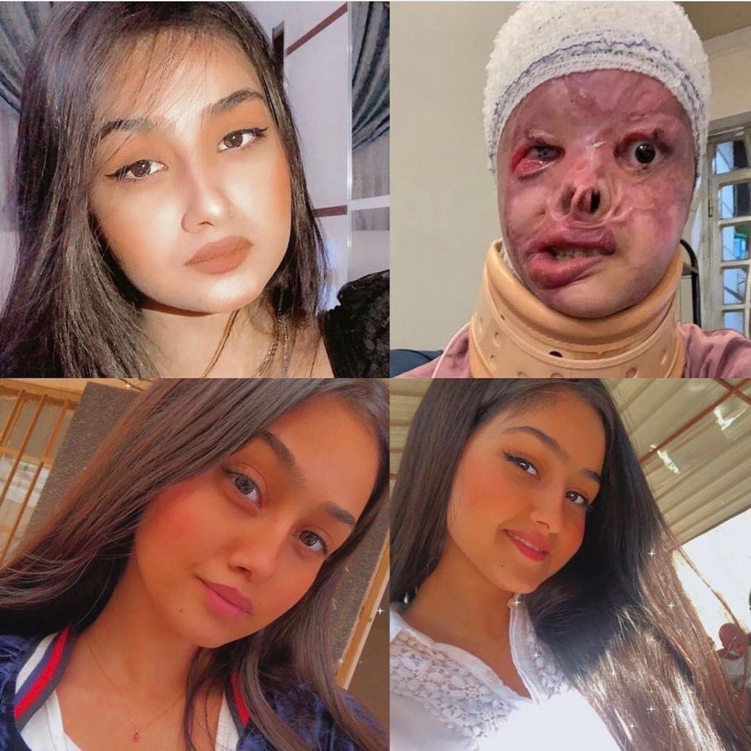 - TW / تعنيف :

- مريم شابة عراقية جميلة 20 سنة طالبة (فنون جميلة). عايشة حياتها سعيدة وحُرة أتقدم لها مجرم. رفضته لأنها شايفة (دراستها وحياتها أهم) . قرر يحرقها (بالتيزاب) ودي مادة شديدة الاشتعال واتقبض عليه وخد حكم مخفف وهيطلع قريب يعيش حياته عادي جداً 

#انقذوا_الاميرة_مريم