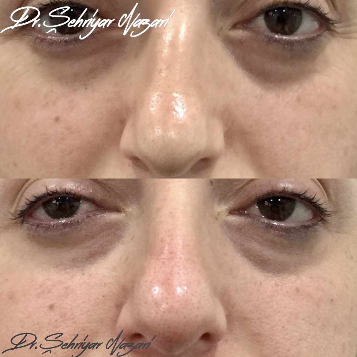 SehriyarDr's tweet photo. Liquid Rhinoplasty 
Correction of assymmetrical problems of the nose is possible by only injection without any need to operation. https://t.co/YBFbs00nuE