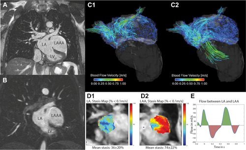 Check out our case “#4DFlow MRI in a Left Atrial Appendage Aneurysm” in #JACCCaseReports showing complex blood flow hemodynamics. Absence of thrombus was confirmed and patient underwent successful aneurysmectomy jacc.org/doi/10.1016/j.…  @JACCjournals @NMCardioVasc @NURadiology
