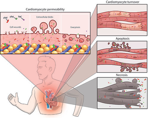 Circulation (@circaha) on Twitter photo #Review What is the relevance of an elevated troponin after exercise? Explore the pathophysiology and clinical significance with <a href="/VAengevaeren/">Vincent Aengevaeren</a> <a href="/ThijsEijsvogels/">Thijs Eijsvogels</a> ahajournals.org/doi/10.1161/CI… #Review What is the relevance of an elevated troponin after exercise? Explore the pathophysiology and clinical significance with <a href="/VAengevaeren/">Vincent Aengevaeren</a> <a href="/ThijsEijsvogels/">Thijs Eijsvogels</a> ahajournals.org/doi/10.1161/CI…