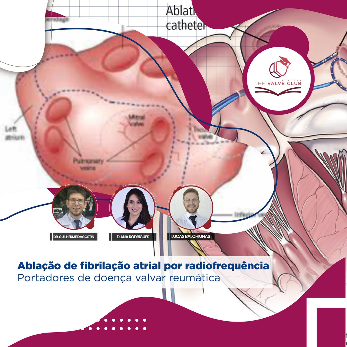 We continue with our Academy program publications! Our Fellows, guided by our tutors, will show the great technical progress achieved.
.
Today, we are going to talk about radiofrequency ablation of AF in valvular heart disease. Awesome!
.
Go to thevalveclub.com.br