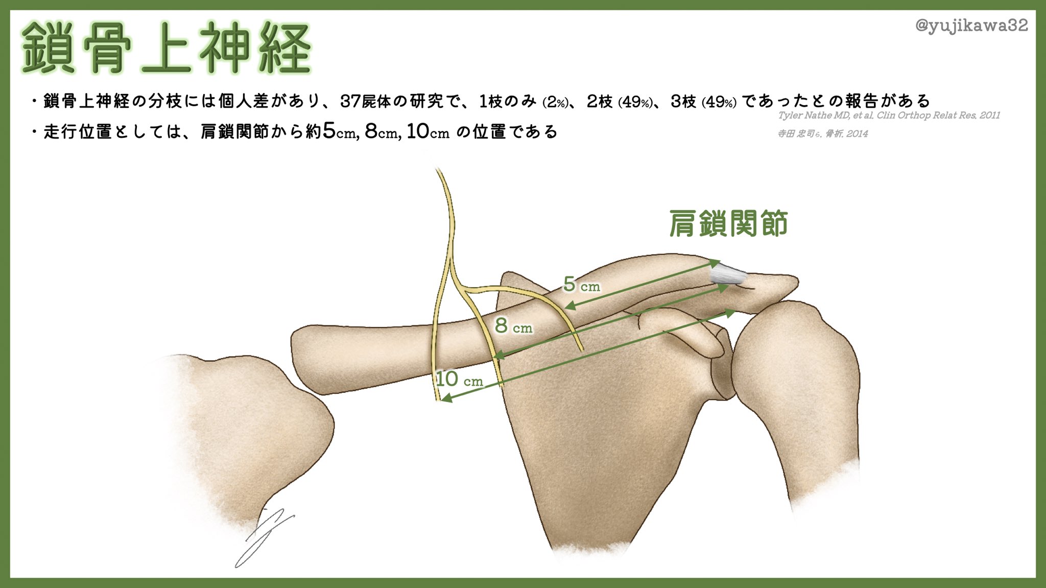 ユジカワ 整形dr イラストレーター 配布資料用に 過去資料をリメイク続けてます 鎖骨周囲の感覚神経である鎖骨 上神経ですが 鎖骨骨折opeの際に損傷することが多い 術前にicしてあえて切ることも それでも 自覚症状が無い場合が半分以上な印象