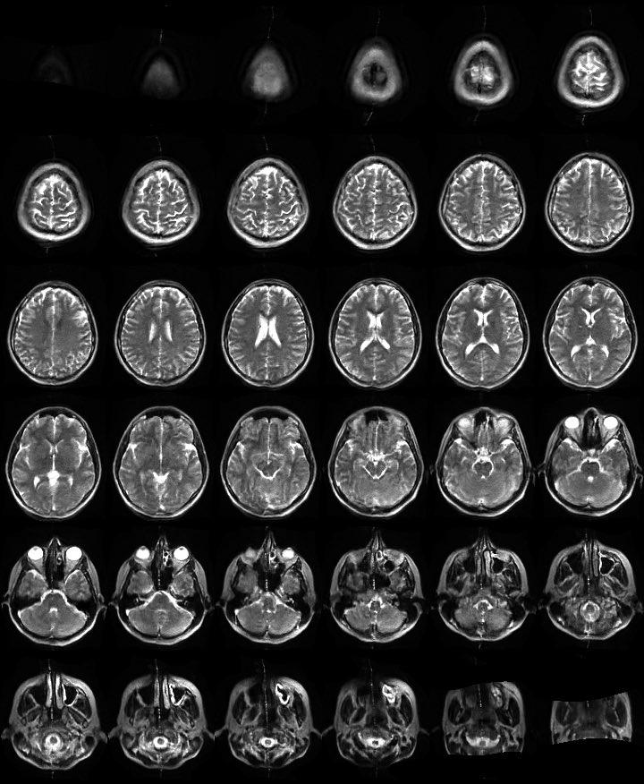 NMCancelliere's tweet photo. Blown away to see the incredible impact mobile #MRI can have on our patients and the #hospital workflow. Proud to be one of the 1st ten #Canadians to have their #brain scanned with this new #technology. #upcare #mobileMRI @Hyperfine @StMichaelsFdn @VitorMendesPer1 https://t.co/80ATw1Wkpd